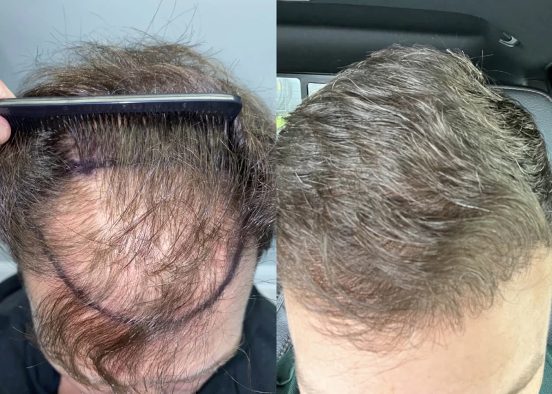 Patient p451 hair transplant before and after tilt view