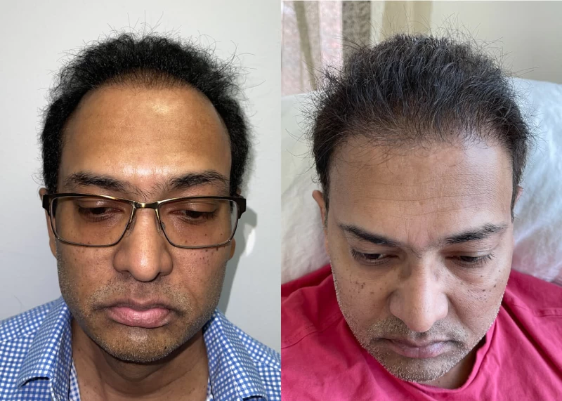 Mr.Px Hair Transplant Before and After