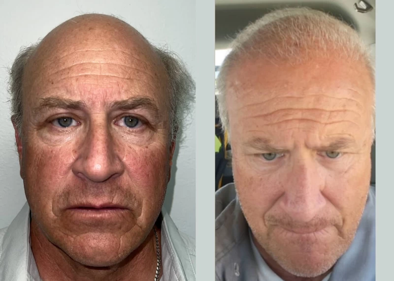 Mr.P453 Hair Transplant Before and After