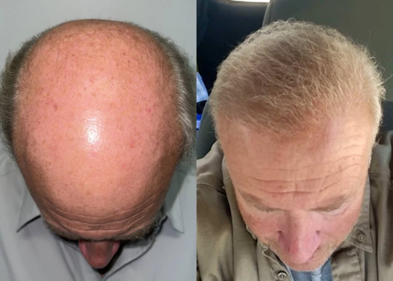 Patient p453 hair transplant before and after tilt view