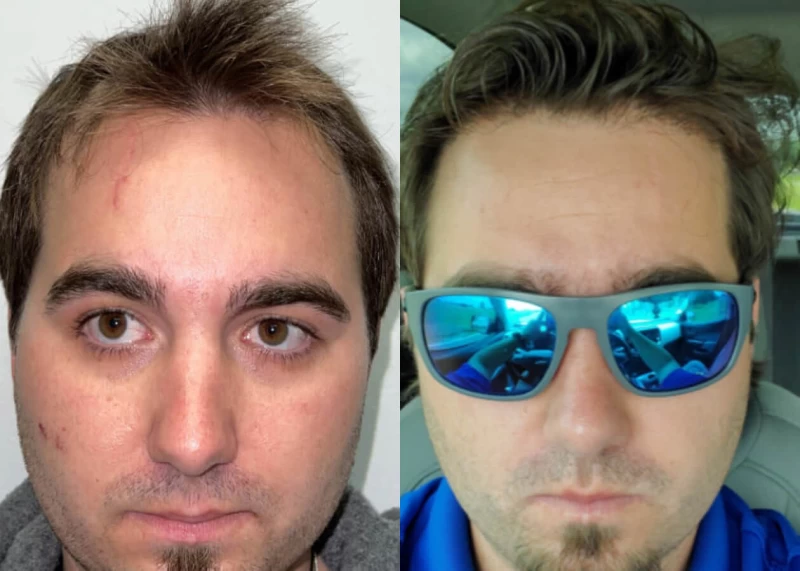 Mr.p454 Hair Transplant Before and After