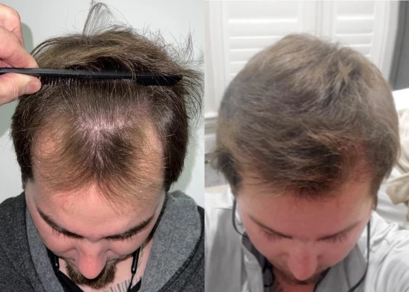 Patient p454 hair transplant before and after tilt view
