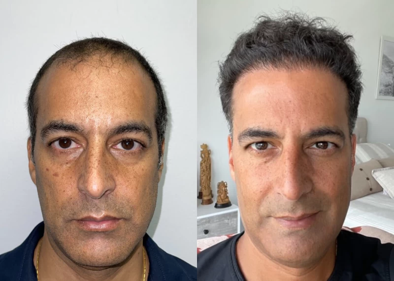 Mr.p455 Hair Transplant Before and After