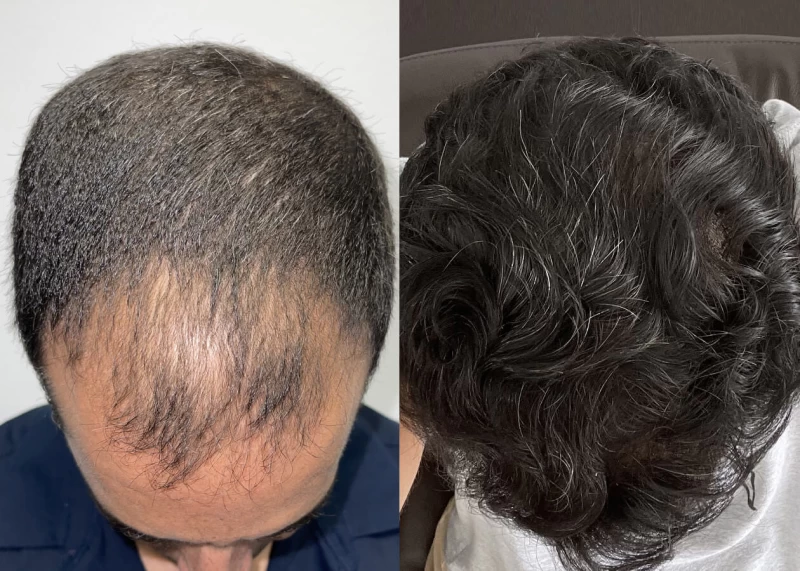 Patient p455 hair transplant before and after tilt view