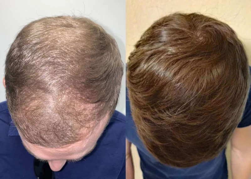 Mr.p456 Hair Transplant Before and After