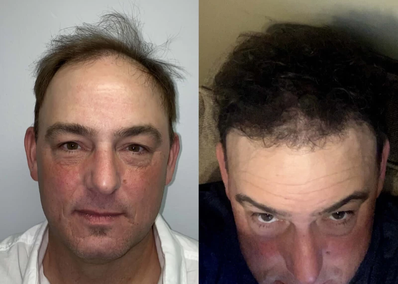 Mr.p457 Hair Transplant Before and After
