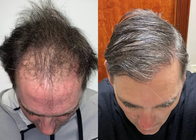 Patient p457 hair transplant before and after tilt view