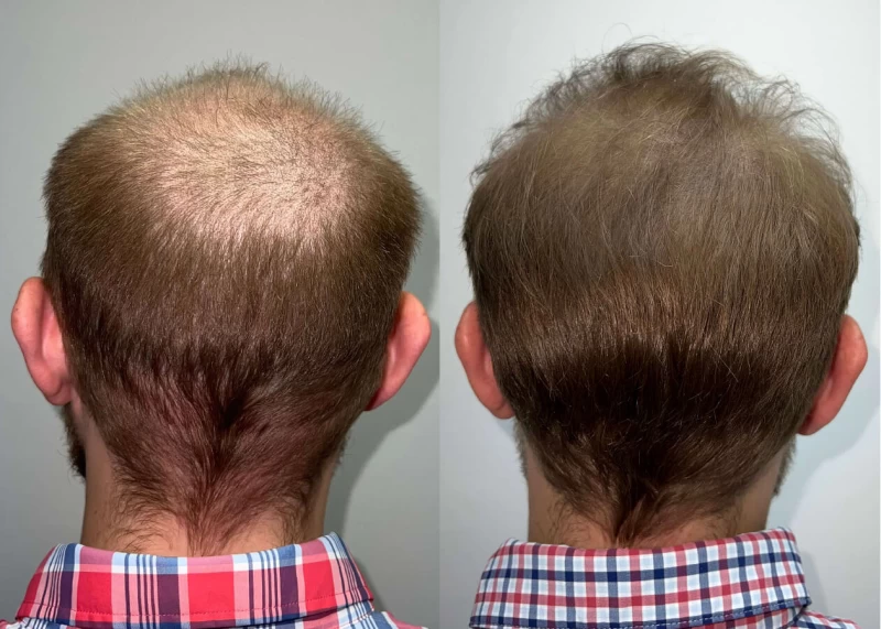 Patient p458 hair transplant before and after crown view