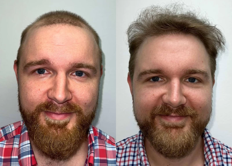 Dillon Hair Transplant Before and After