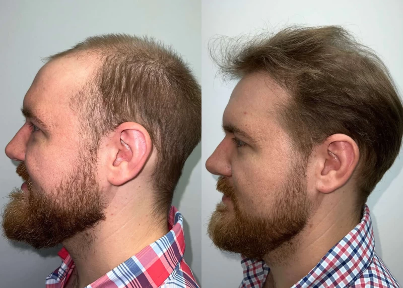 Patient p458 hair transplant before and after left view
