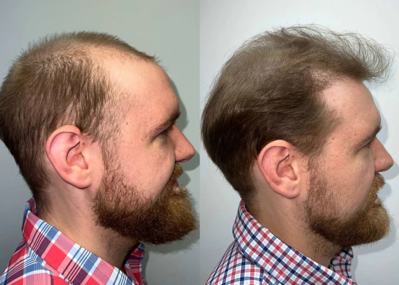 Patient p458 hair transplant before and after right view