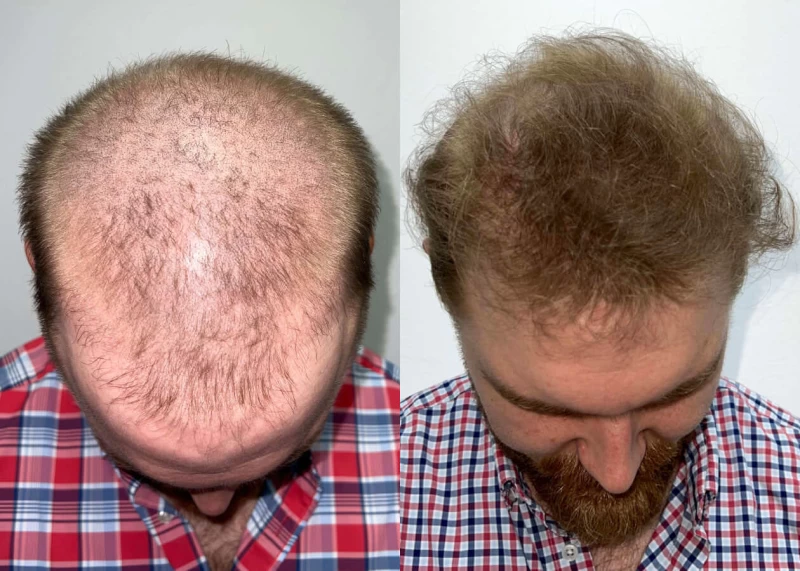 Patient p458 hair transplant before and after tilt view