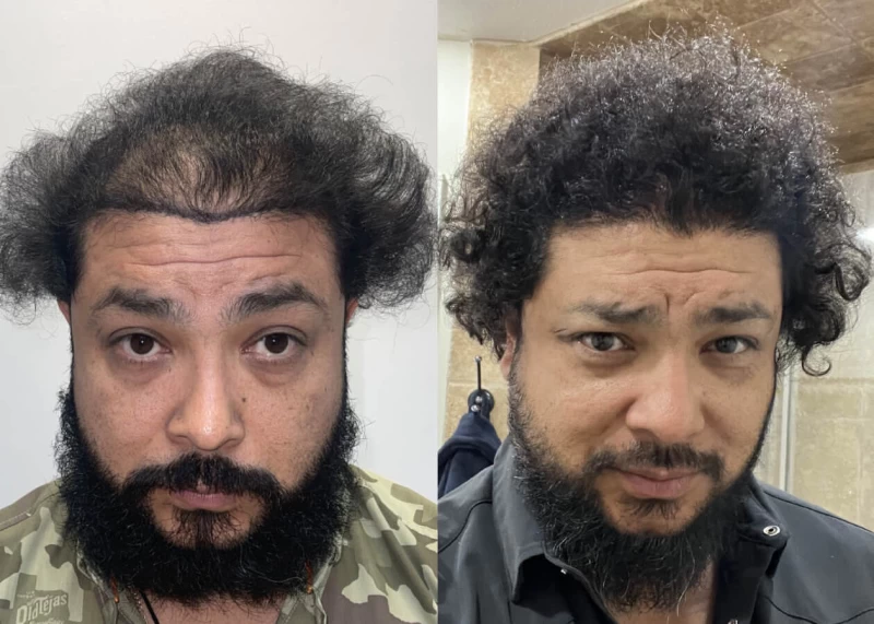 Mr.p459 Hair Transplant Before and After