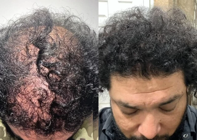 Patient p459 hair transplant before and after tilt view