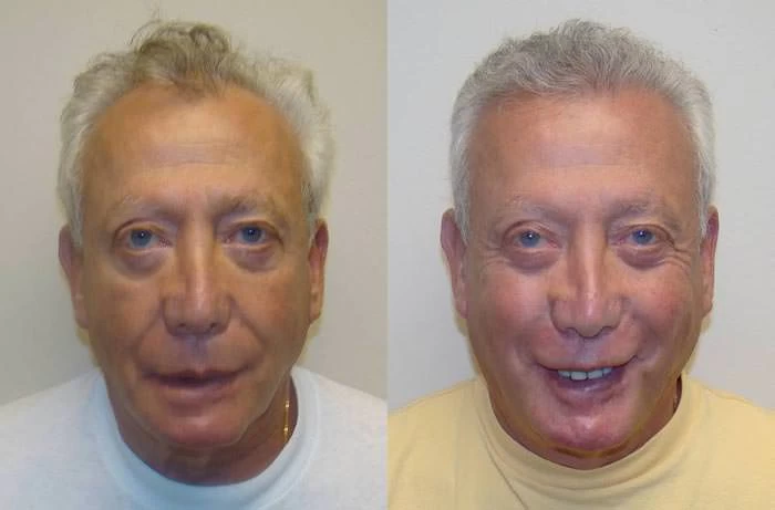 John Hair Transplant Before and After