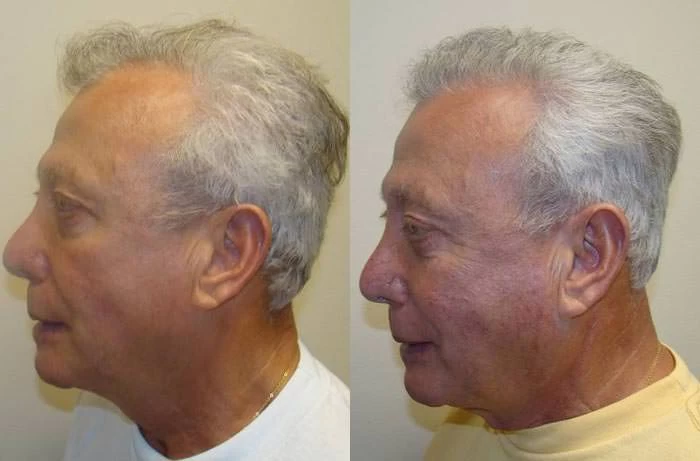Patient p45 hair transplant before and after left view