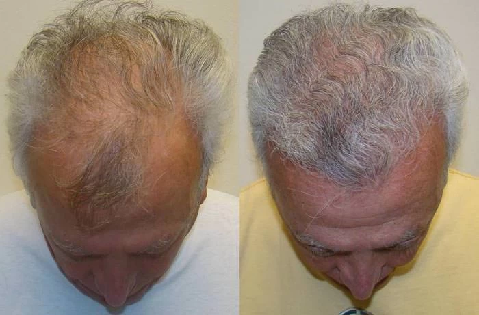 Patient p45 hair transplant before and after tilt view