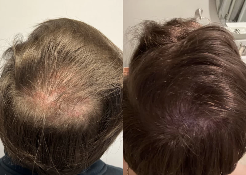 Patient p460 hair transplant before and after crown view