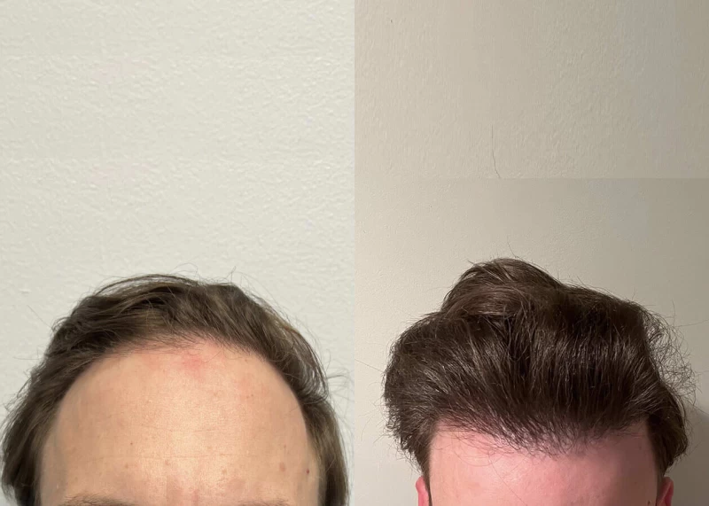 Mr.p460 Hair Transplant Before and After