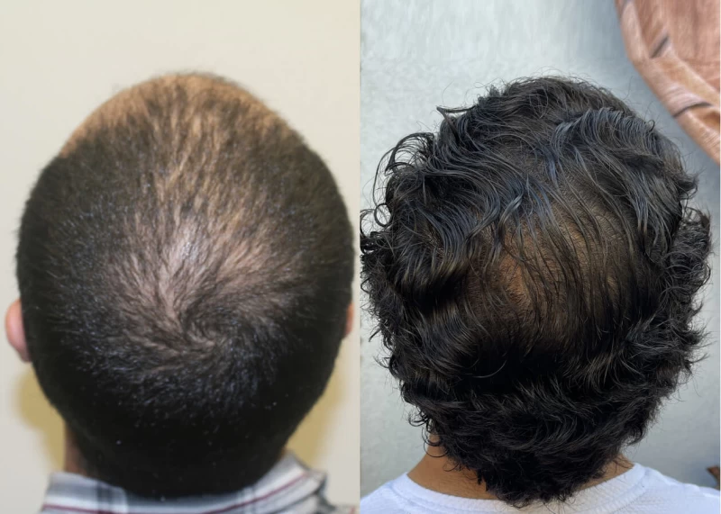 Patient p461 hair transplant before and after crown view
