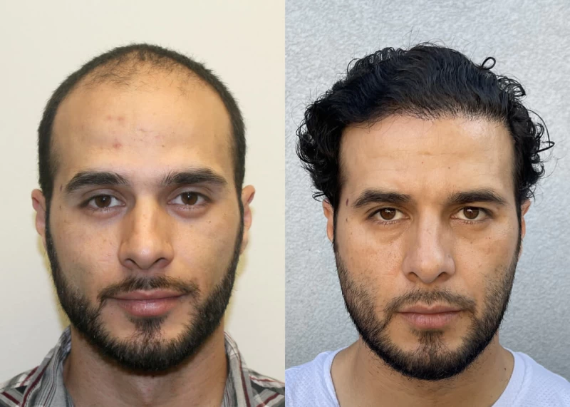 Ramirez Hair Transplant Before and After