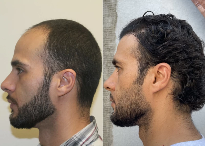 Patient p461 hair transplant before and after left view