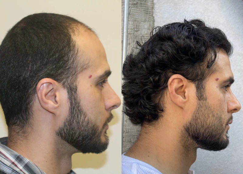 Patient p461 hair transplant before and after right view