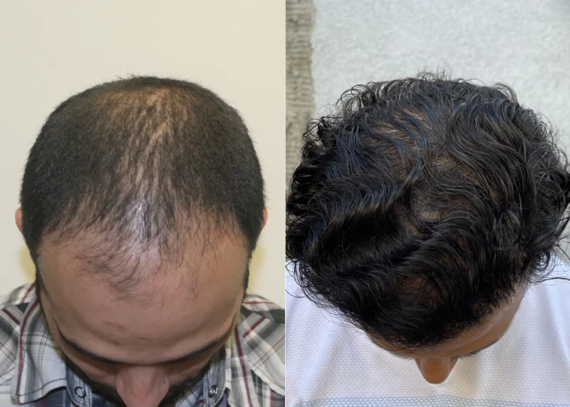 Patient p461 hair transplant before and after tilt view