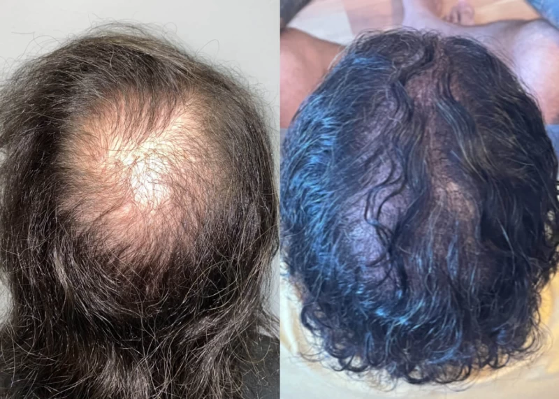 Patient p462 hair transplant before and after crown view