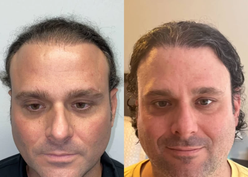 Chad Hair Transplant Before and After