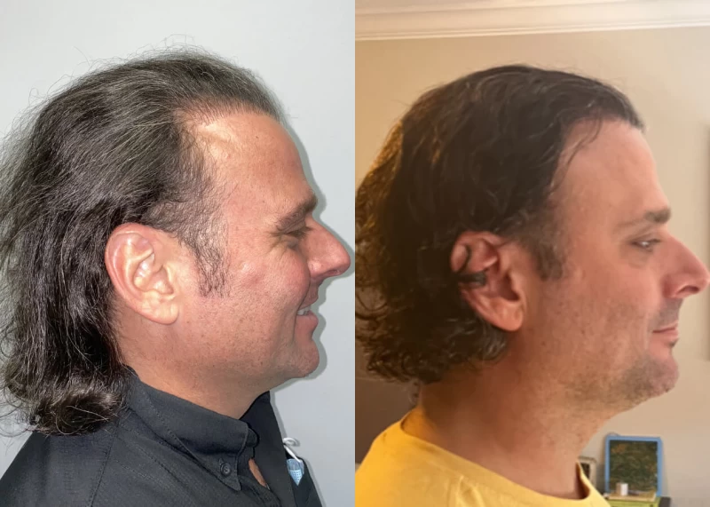 Patient p462 hair transplant before and after right view