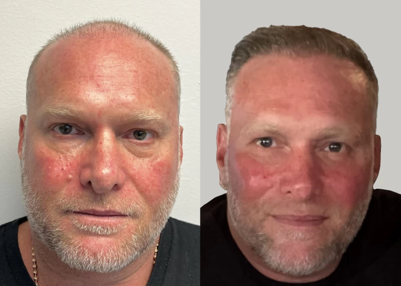 Mr.p463 Hair Transplant Before and After