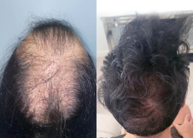 Patient p464 hair transplant before and after crown view