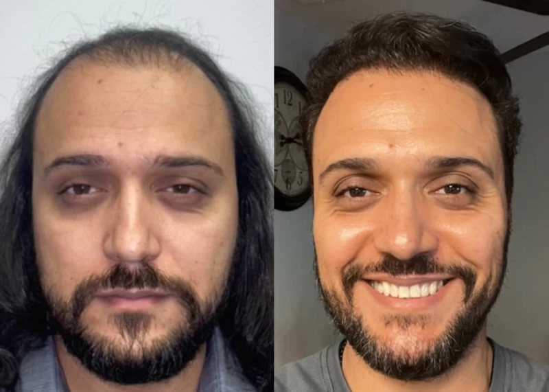 Mr.p464 Hair Transplant Before and After