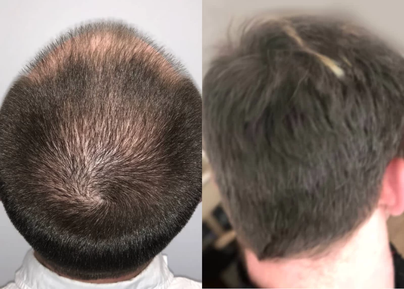 Patient p465 hair transplant before and after crown view