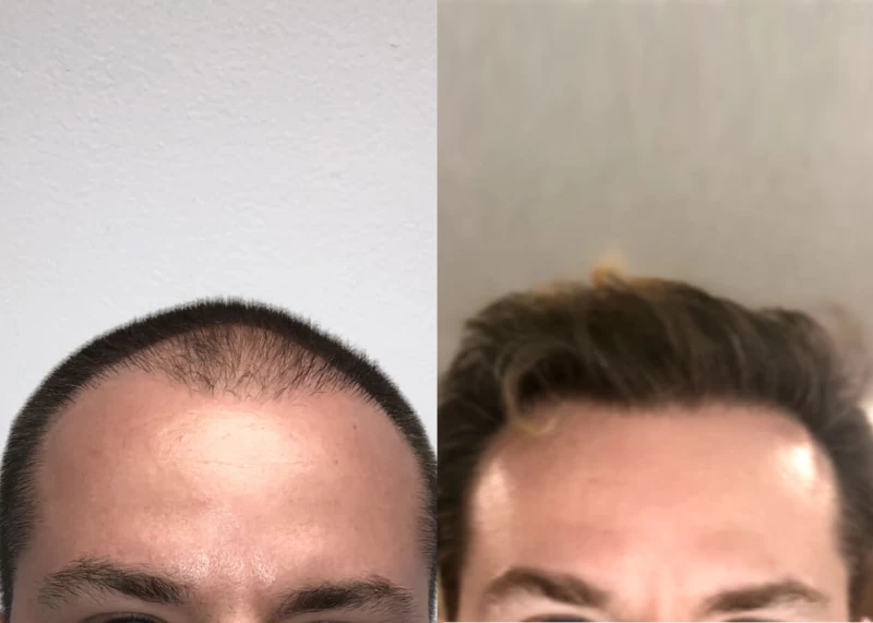 Mr.p465 Hair Transplant Before and After