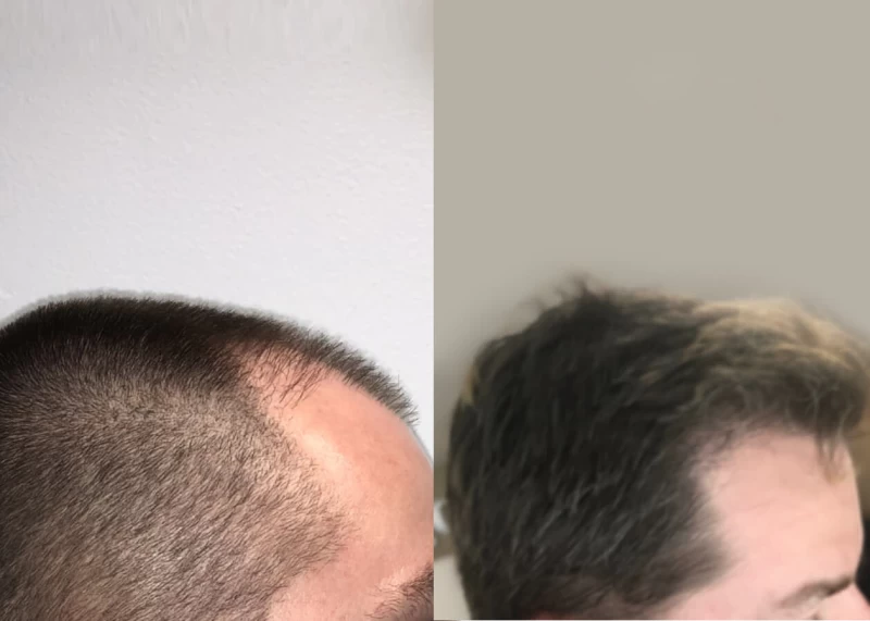 Patient p465 hair transplant before and after right view