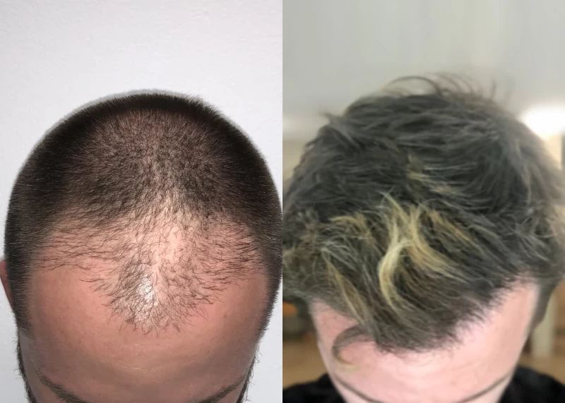 Patient p465 hair transplant before and after tilt view