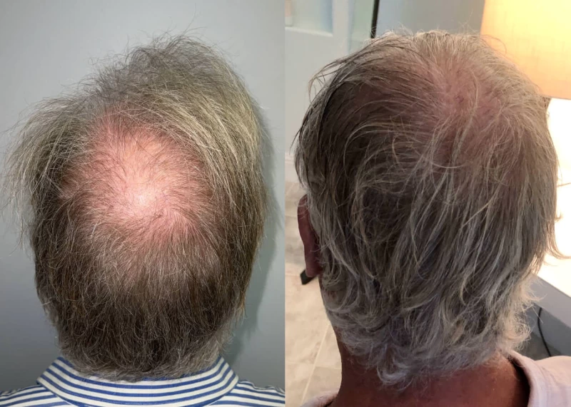 Patient p466 hair transplant before and after crown view