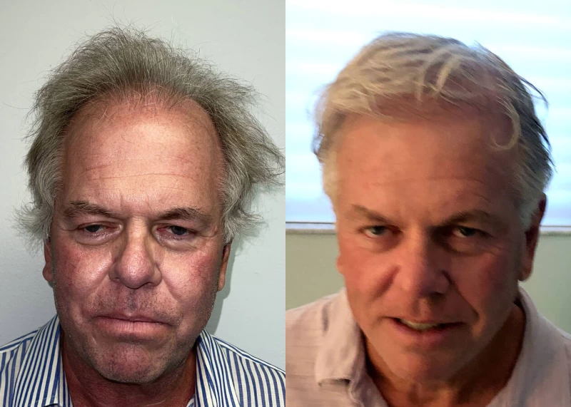Mr.p466 Hair Transplant Before and After
