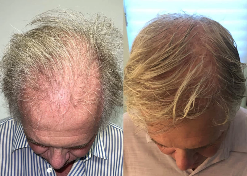 Patient p466 hair transplant before and after tilt view