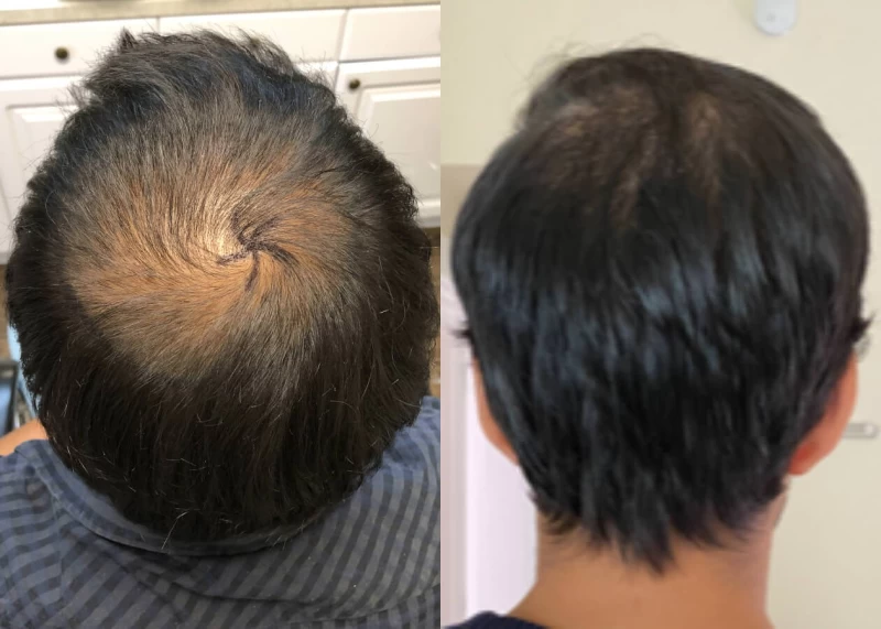 Mr.p467 Hair Transplant Before and After