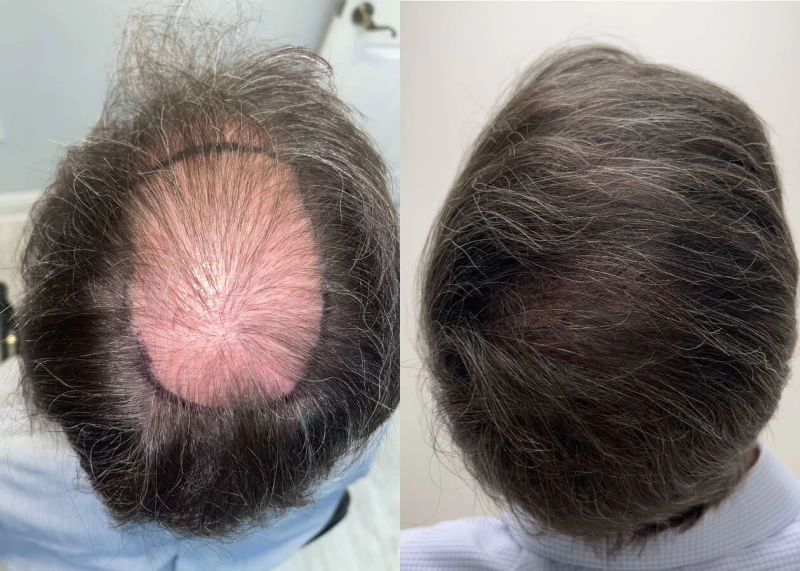 Patient p468 hair transplant before and after crown view