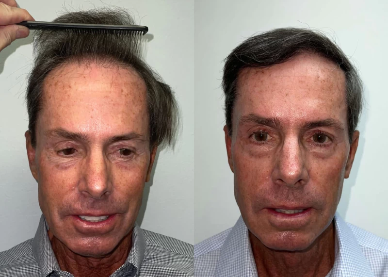 Mike Hair Transplant Before and After