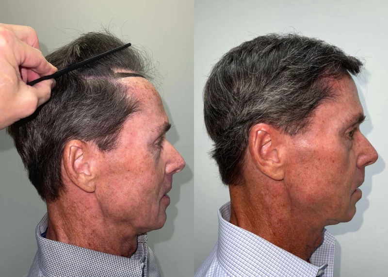 Patient p468 hair transplant before and after right view