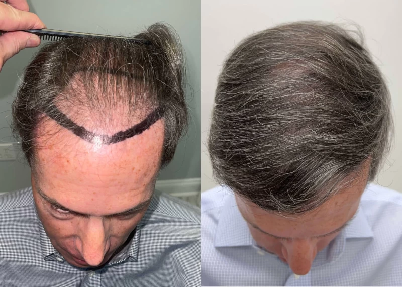 Patient p468 hair transplant before and after tilt view