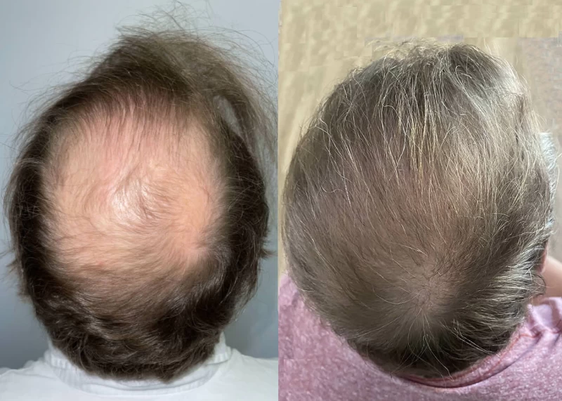 Mr.p469 Hair Transplant Before and After