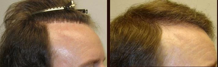 Patient p46 hair transplant before and after right view