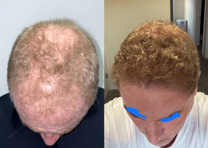 Mr.p470 Hair Transplant Before and After
