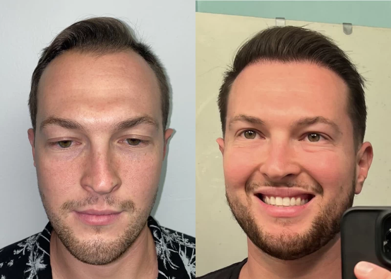 Mr.p471 Hair Transplant Before and After